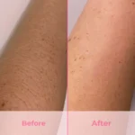 IPL Laser Hair Removal Handset - Image 5